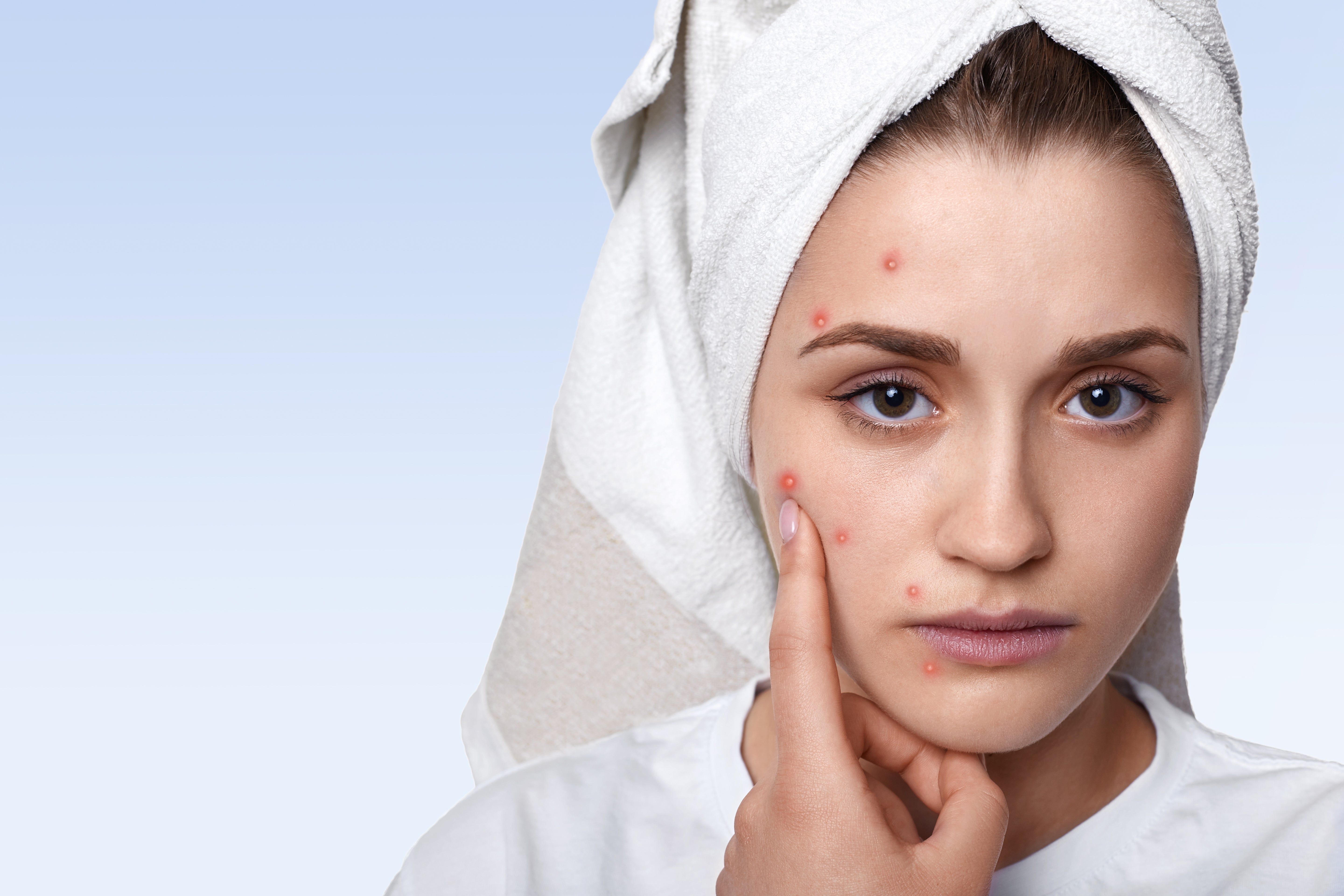 Skincare for Acne Prone Skin